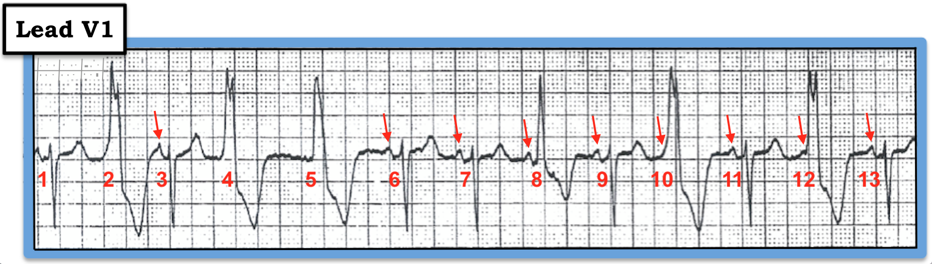 ECG Figure