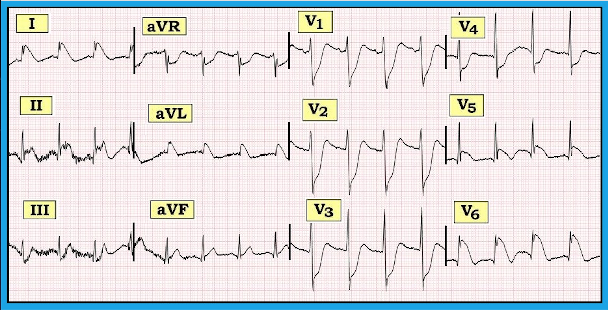 ECG Review