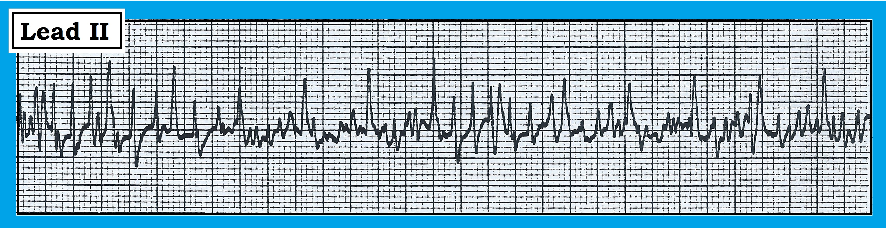 ECG Figure