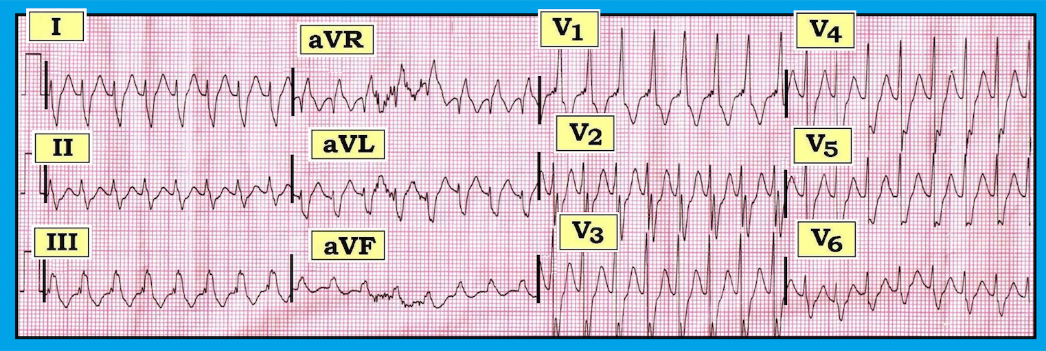 ECG Review