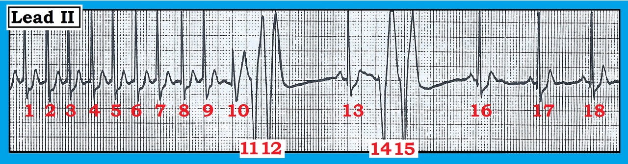 ECG Review Figure