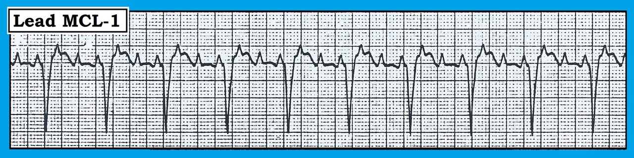 ECG Figure
