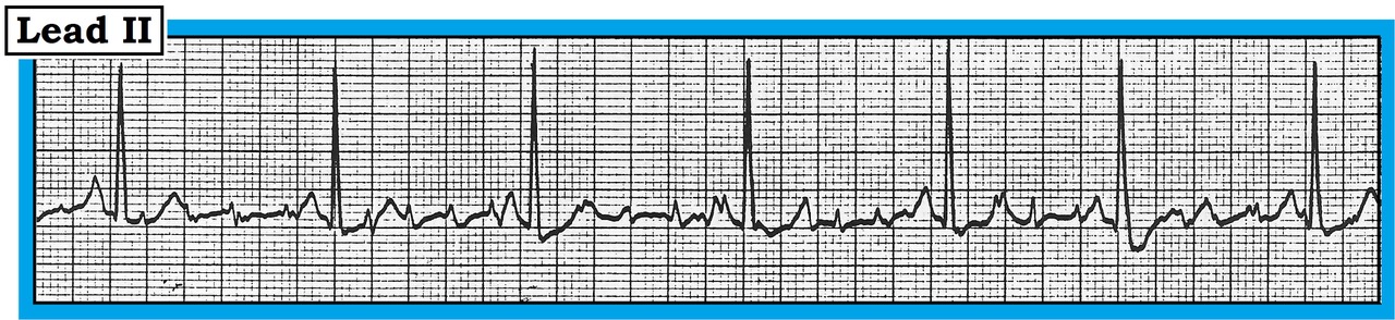 ECG Review