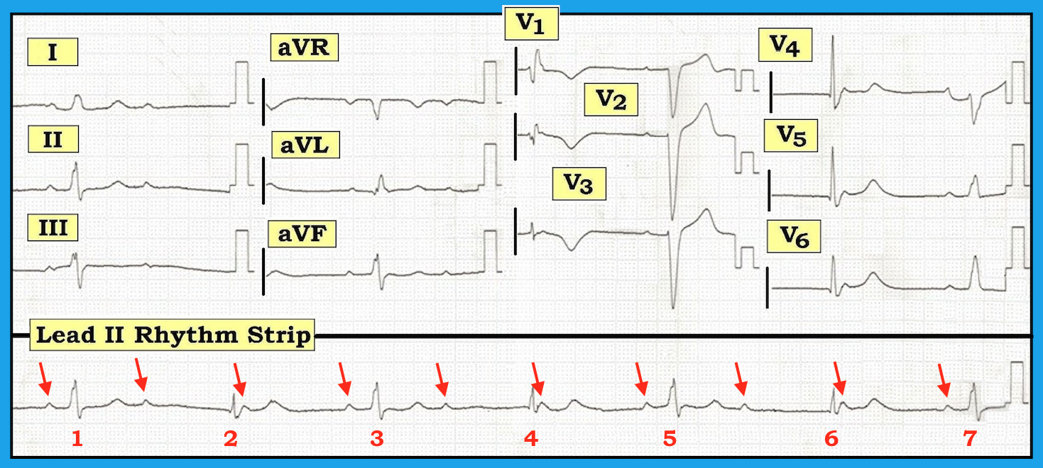 ECG Review