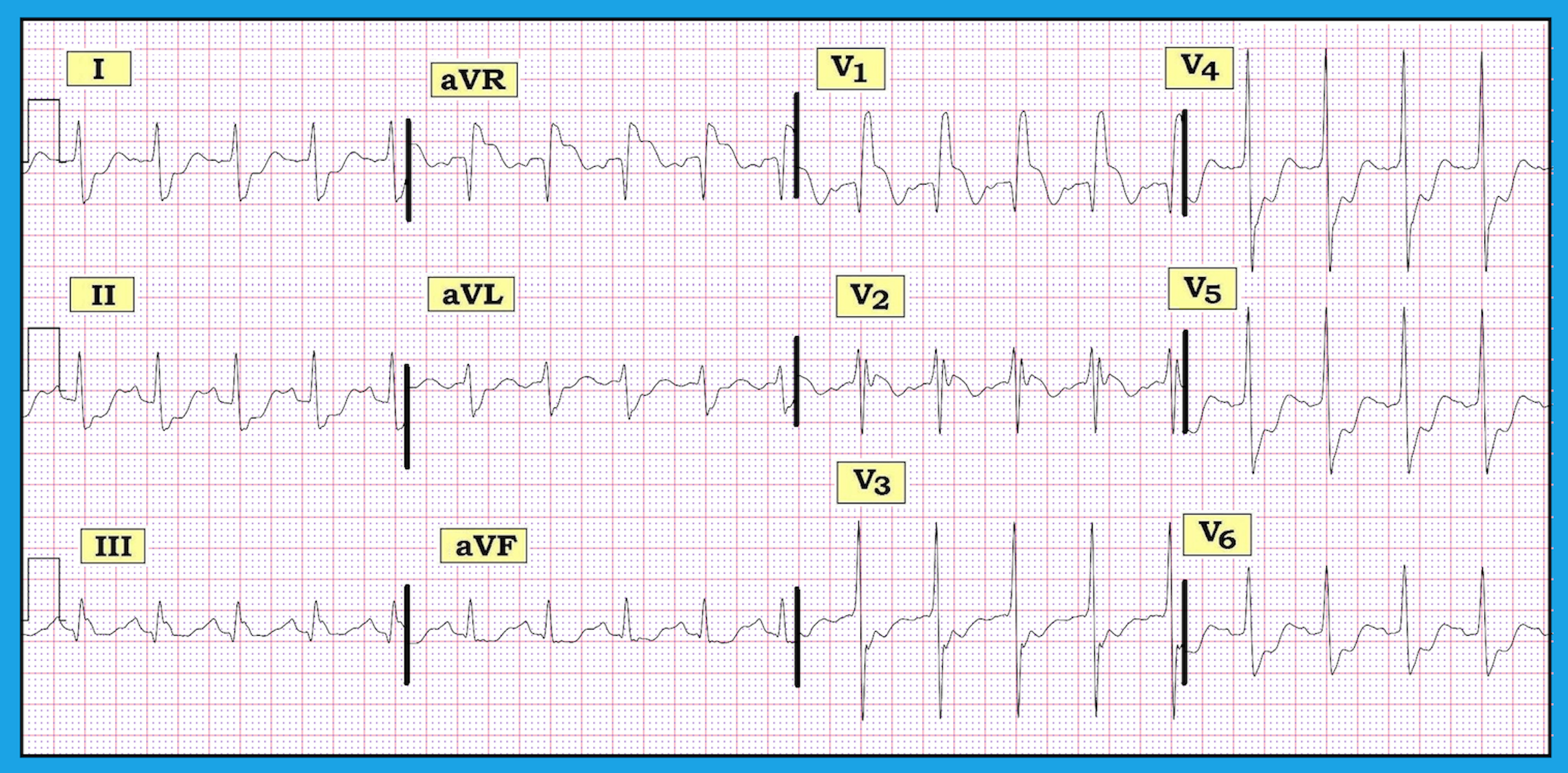 ECG Review