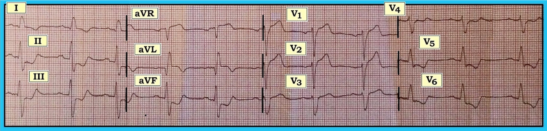 ECG Review