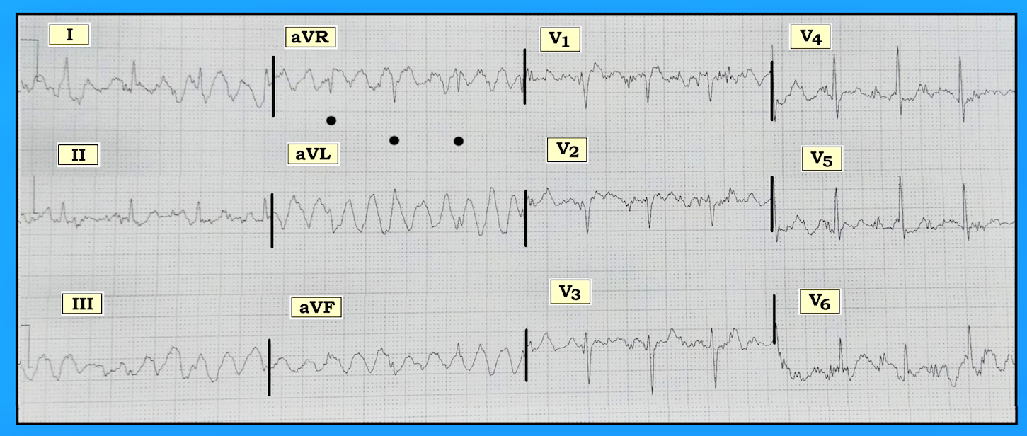 ECG Figure