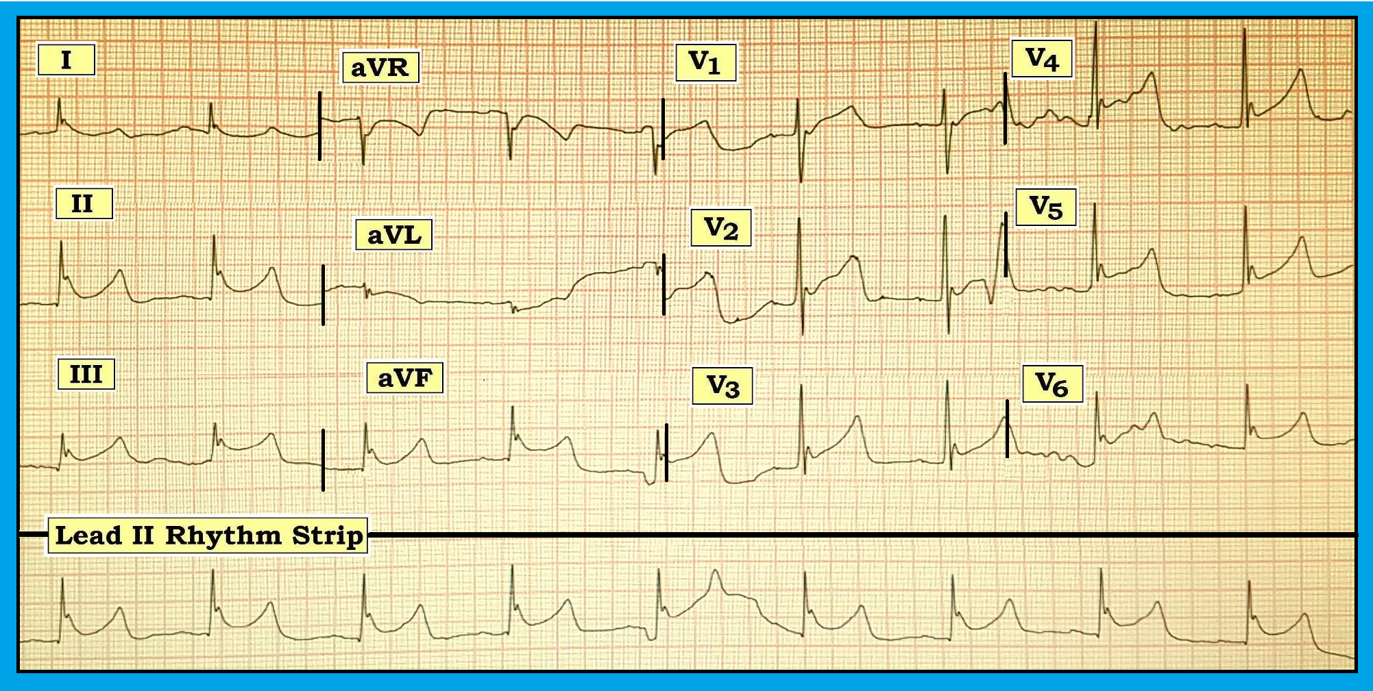 ECG Review