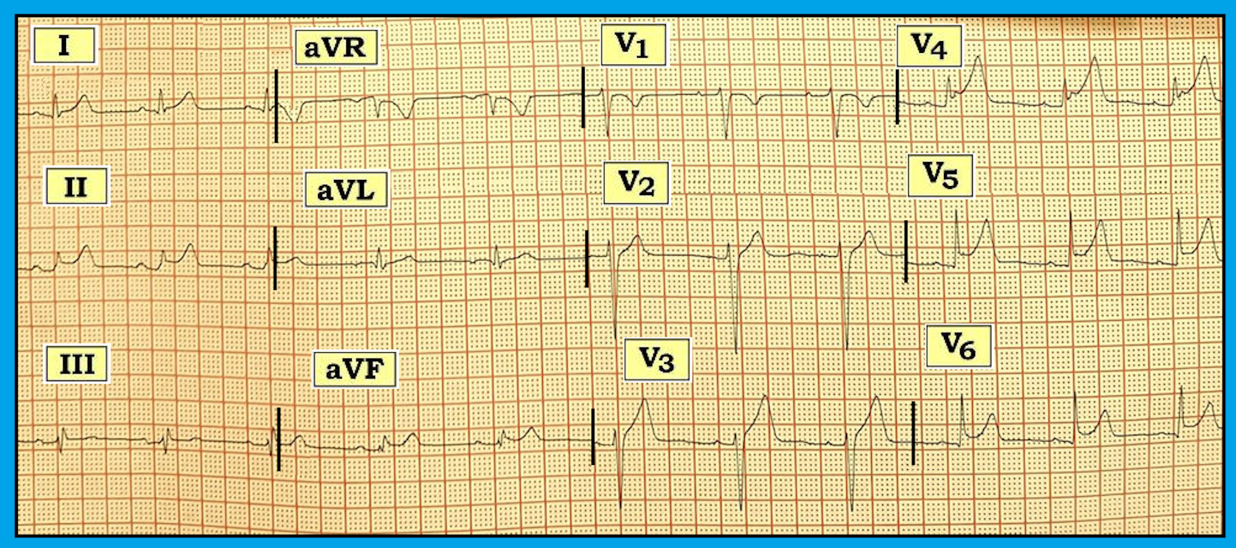 ECG Review