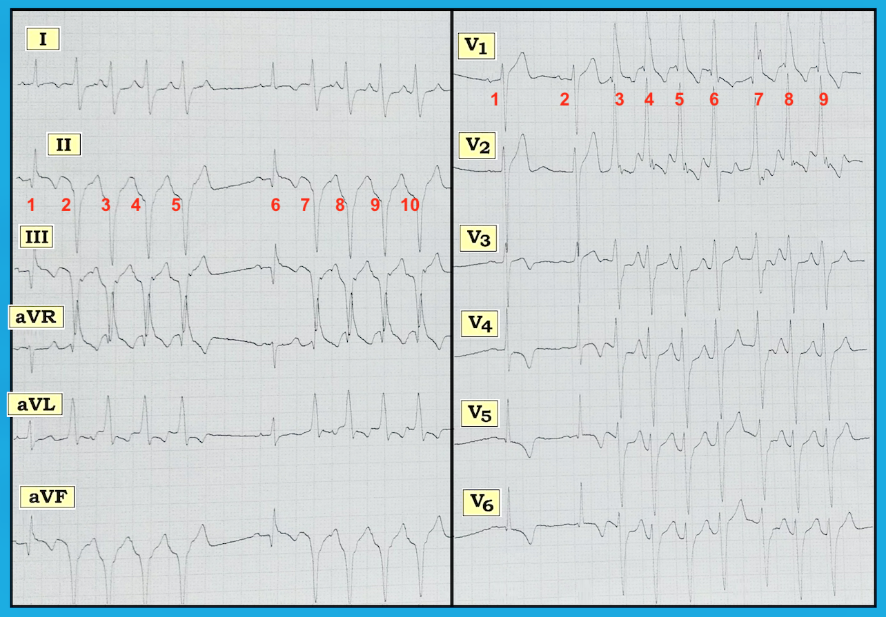 ECG Review