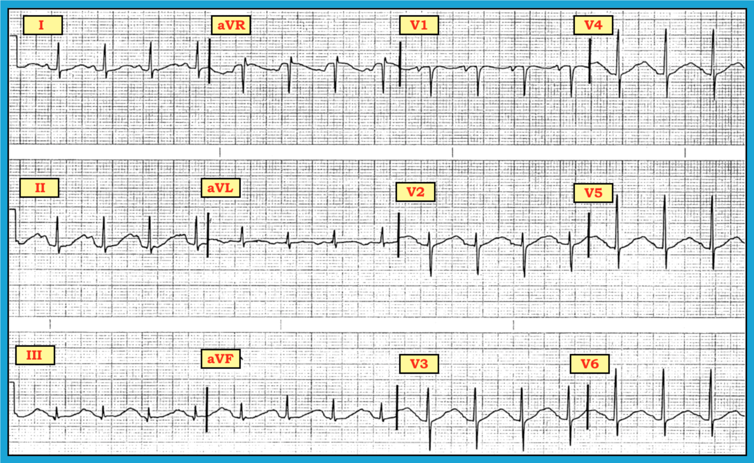 ECG Review