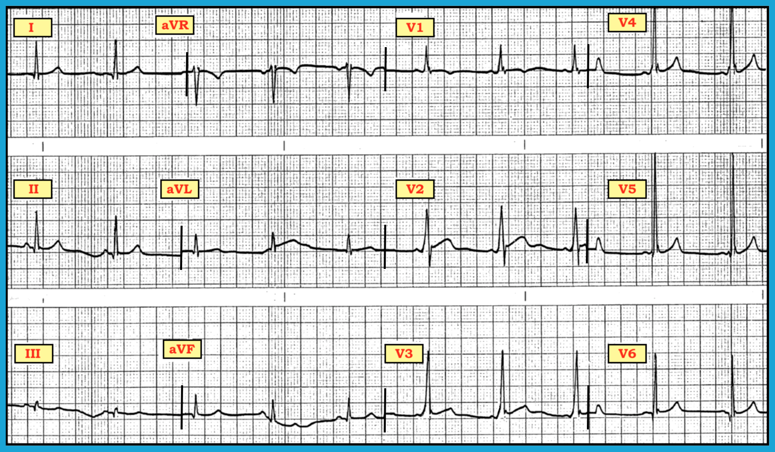 ECG Review
