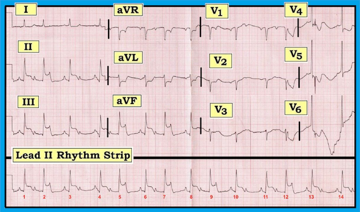 ECG Review