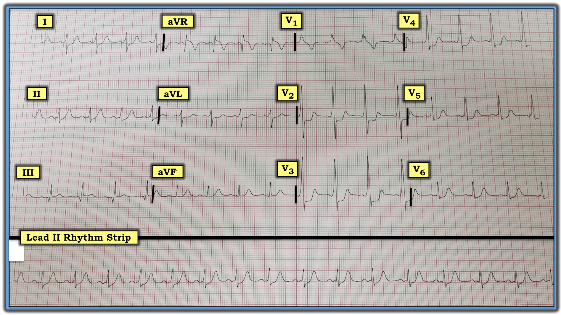 ECG Review
