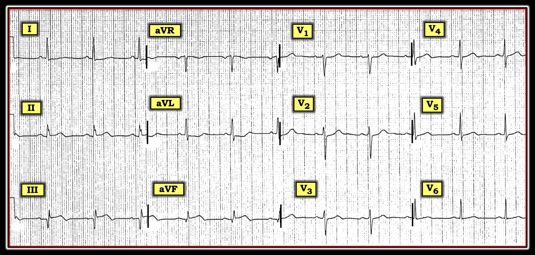 ECG Review