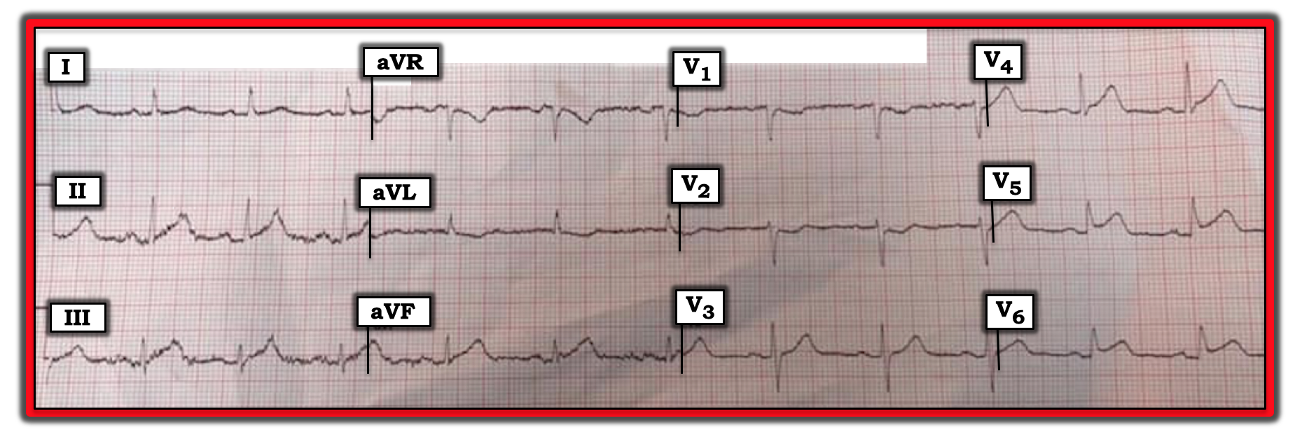 ECG Review