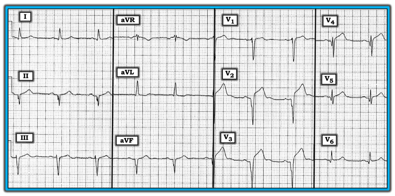 ECG Review