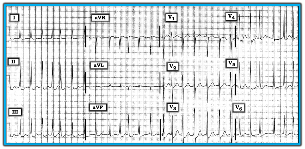 ECG Review