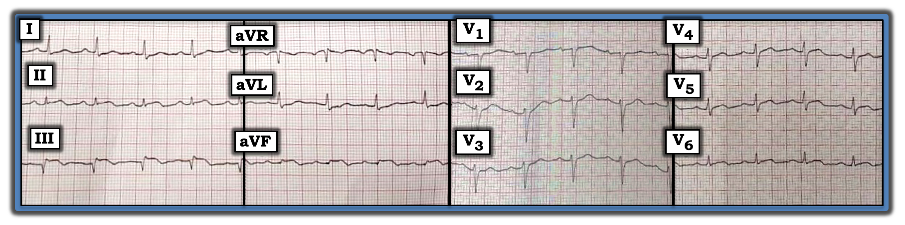 ECG Review