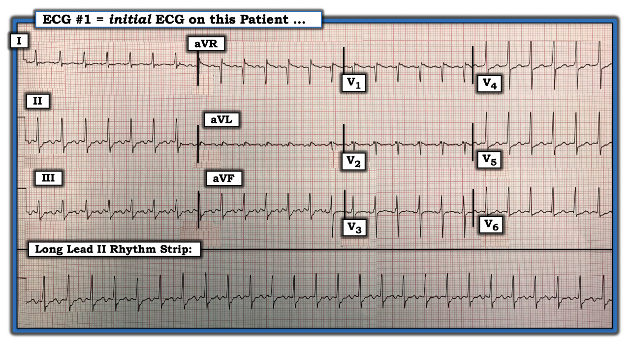ECG Review