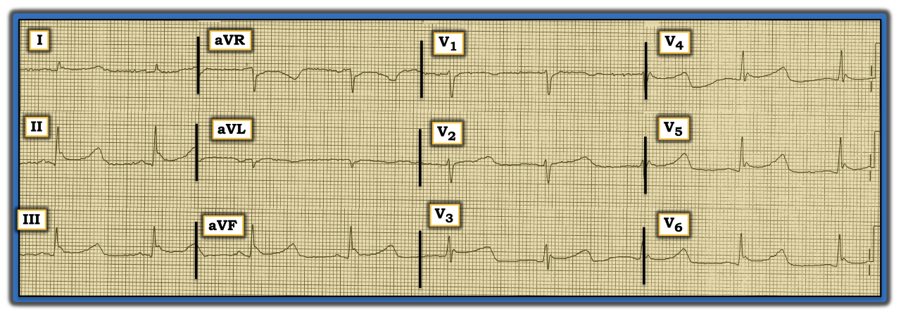 ECG Review
