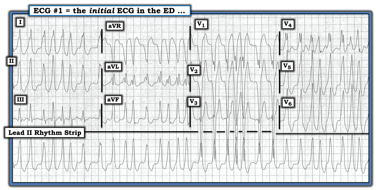 ECG Review