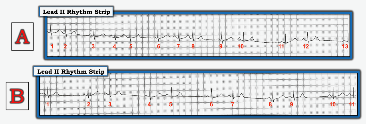 ECG Review