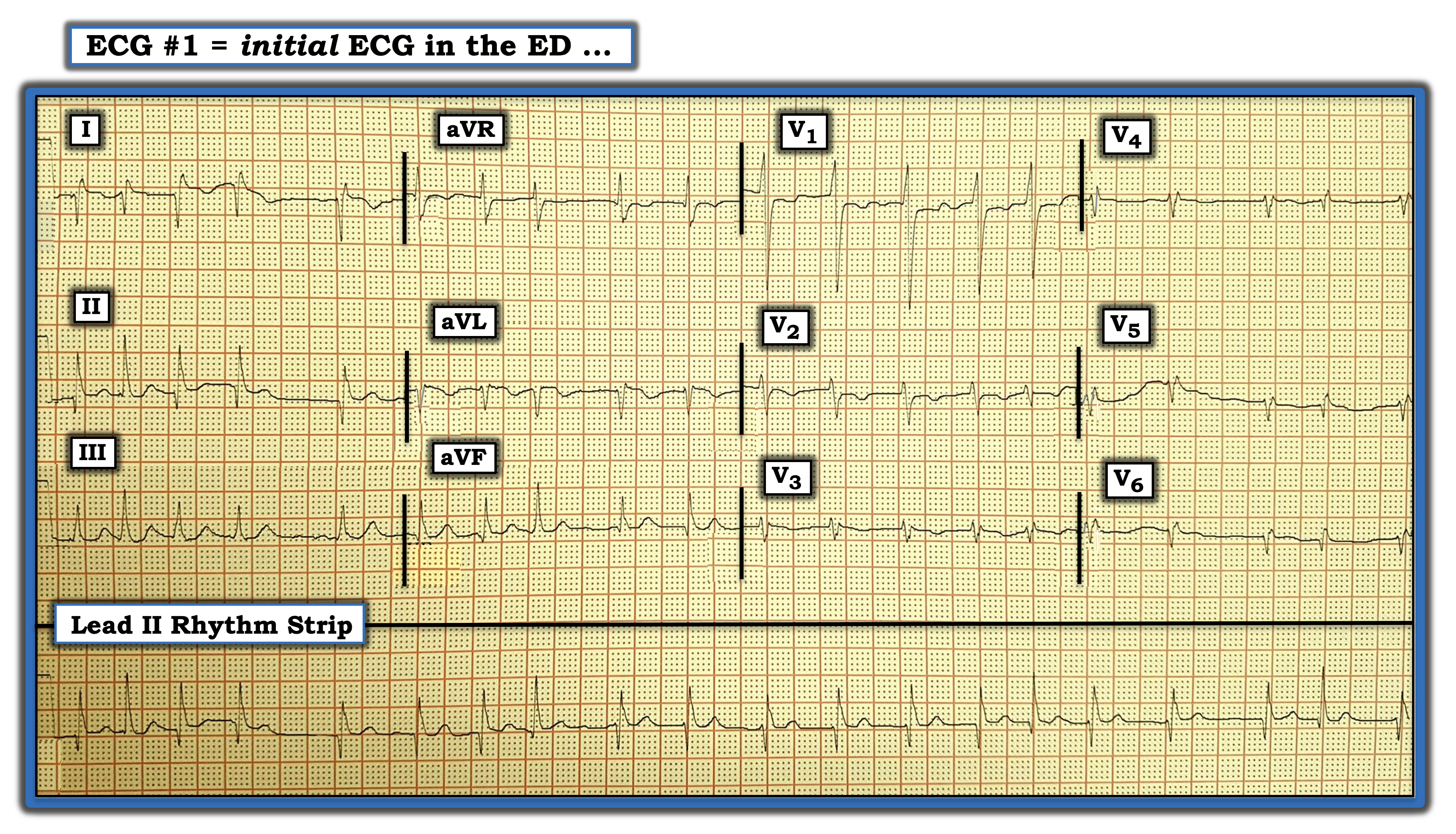 ECG Review