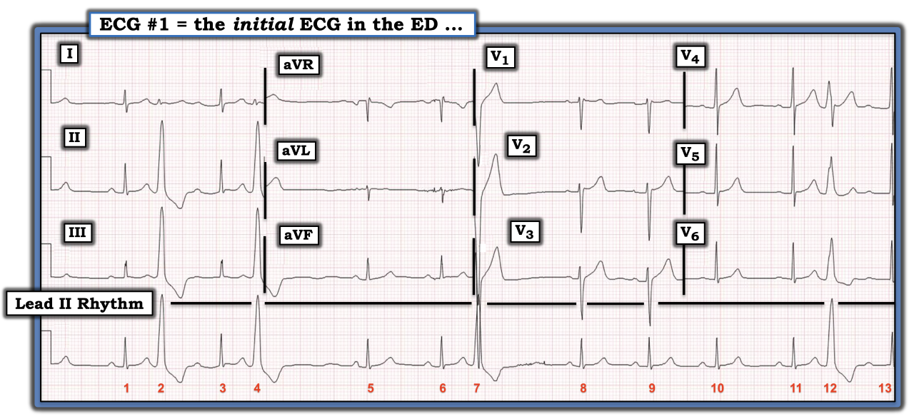 ECG Review