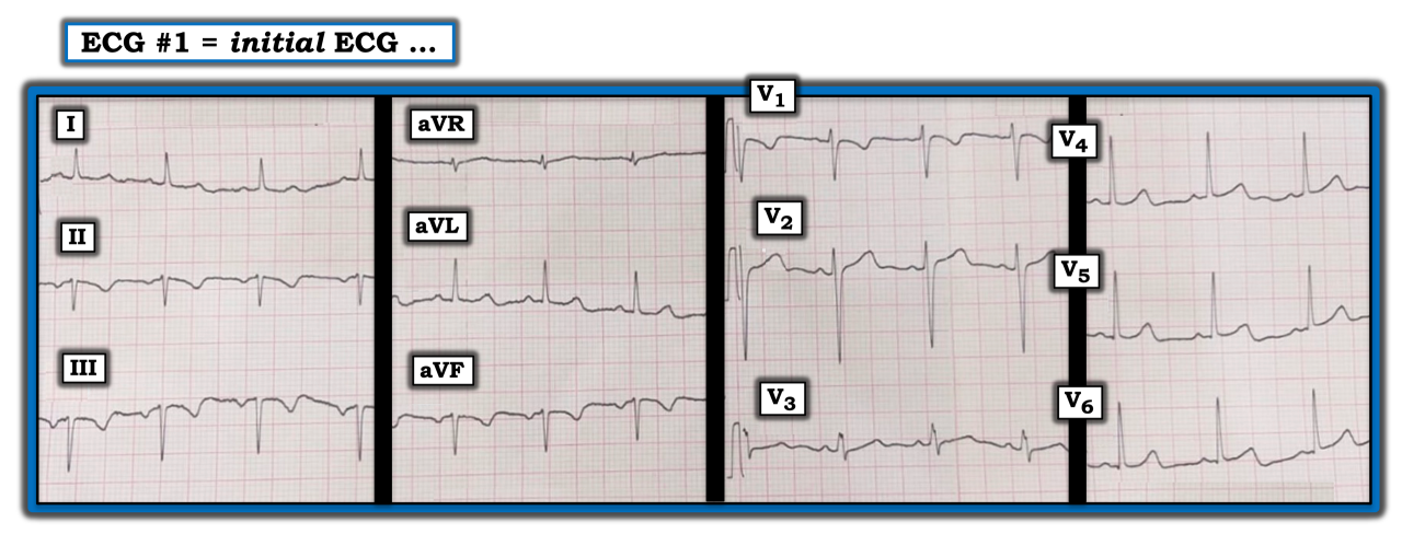 ECG Review