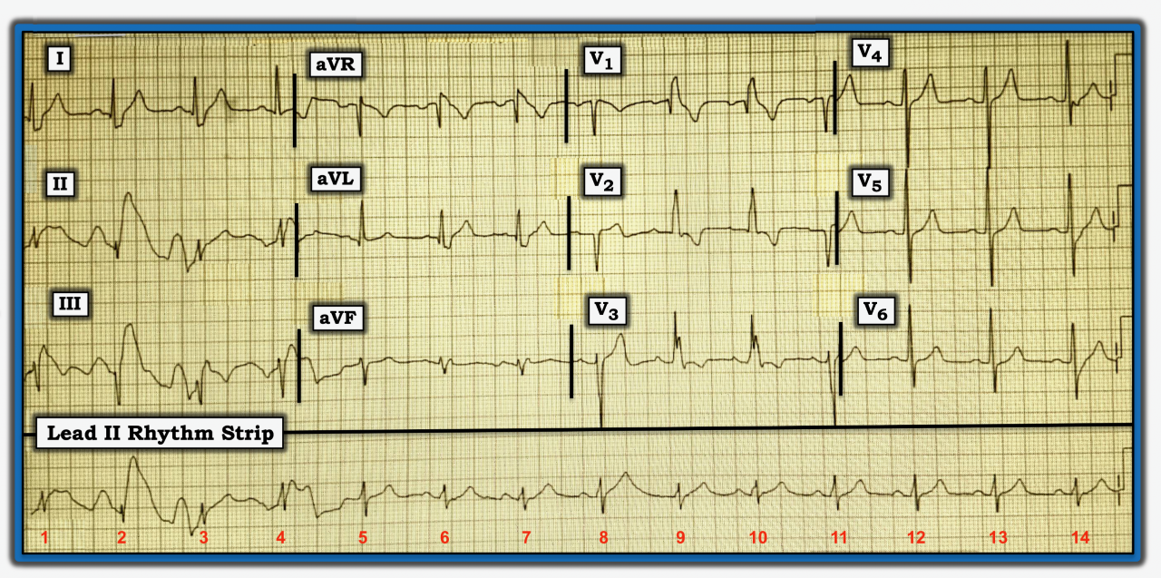 ECG Review