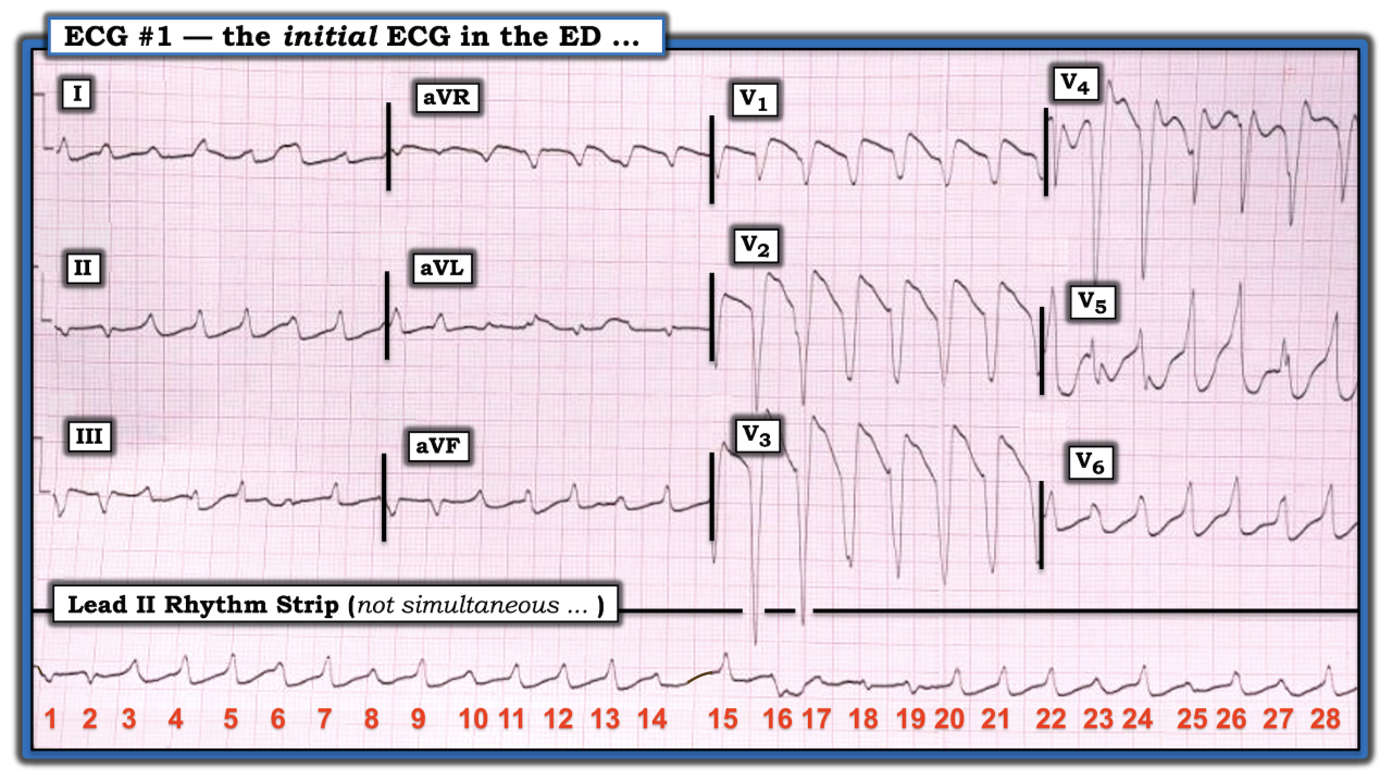 ECG Review