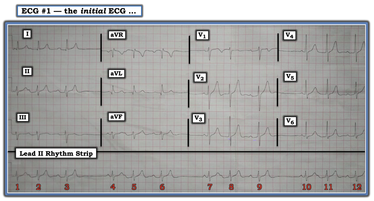ECG Review