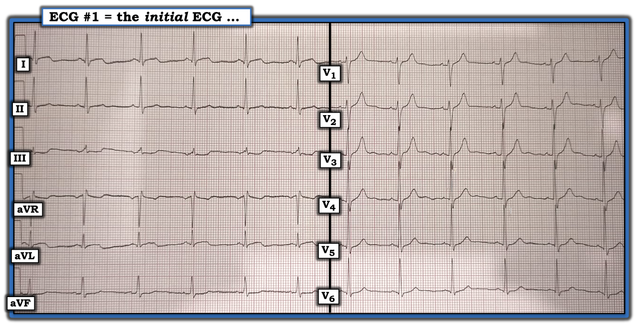 ECG Review