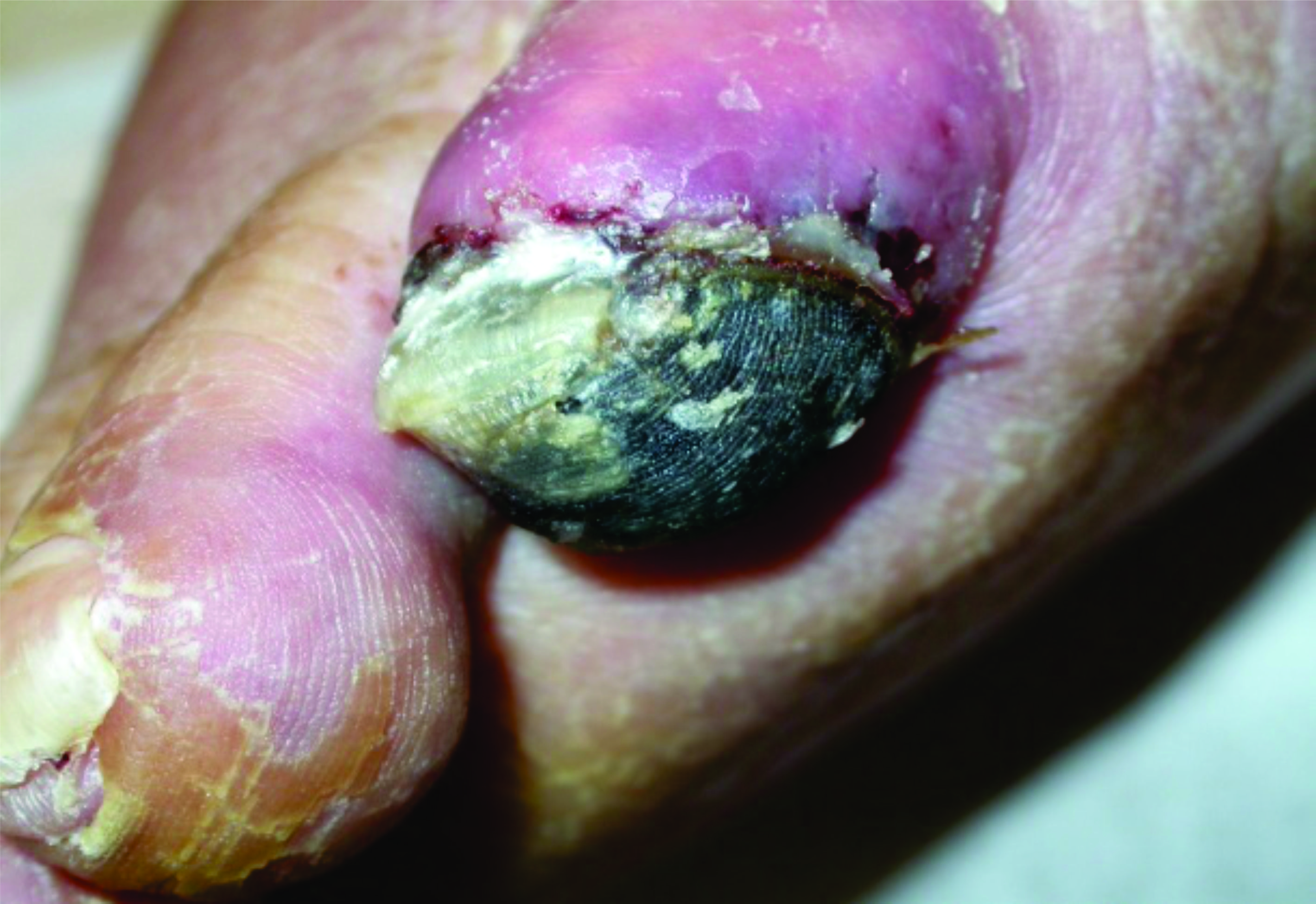 Arterial Wound