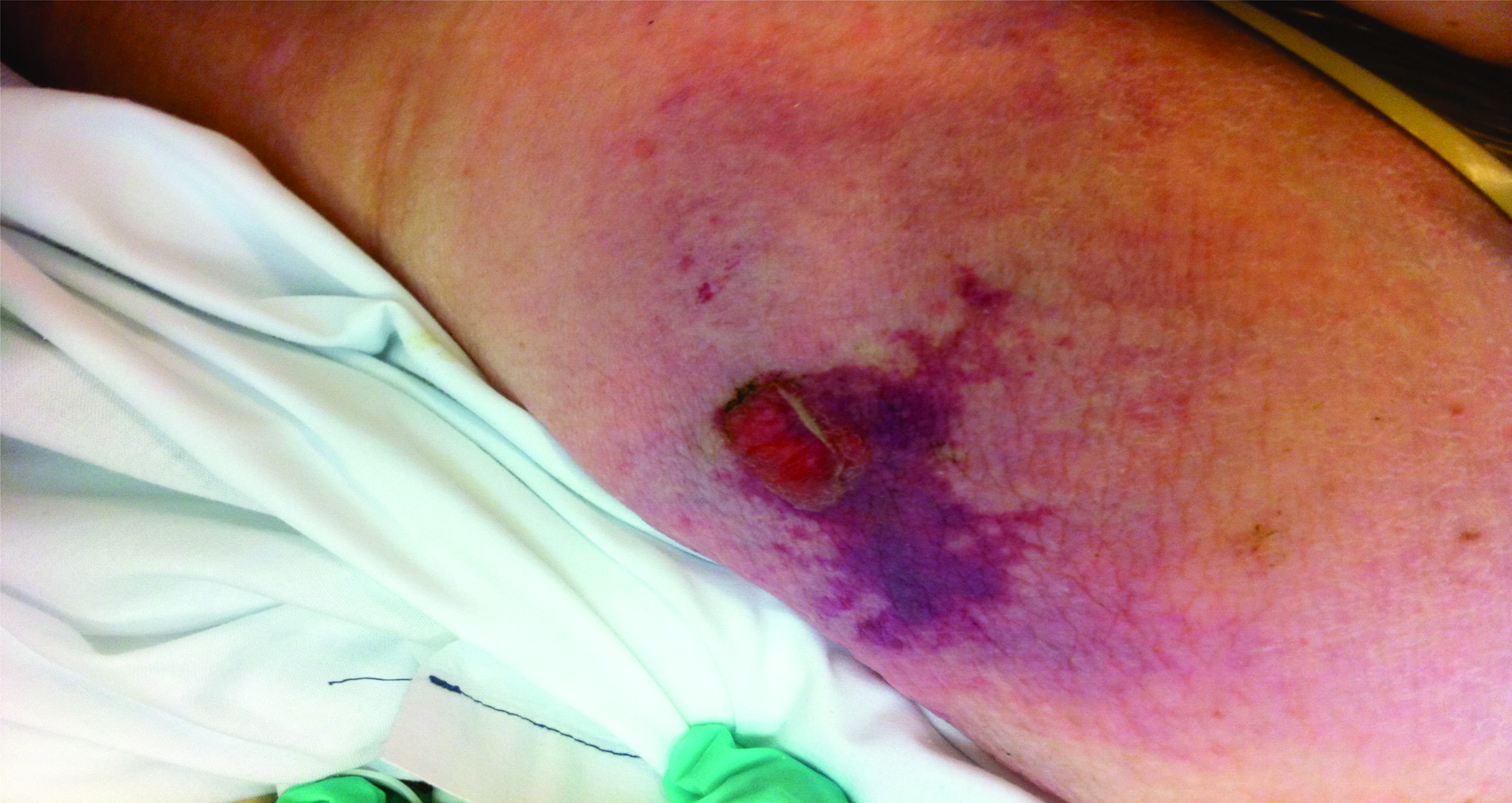 Atypical early Wound