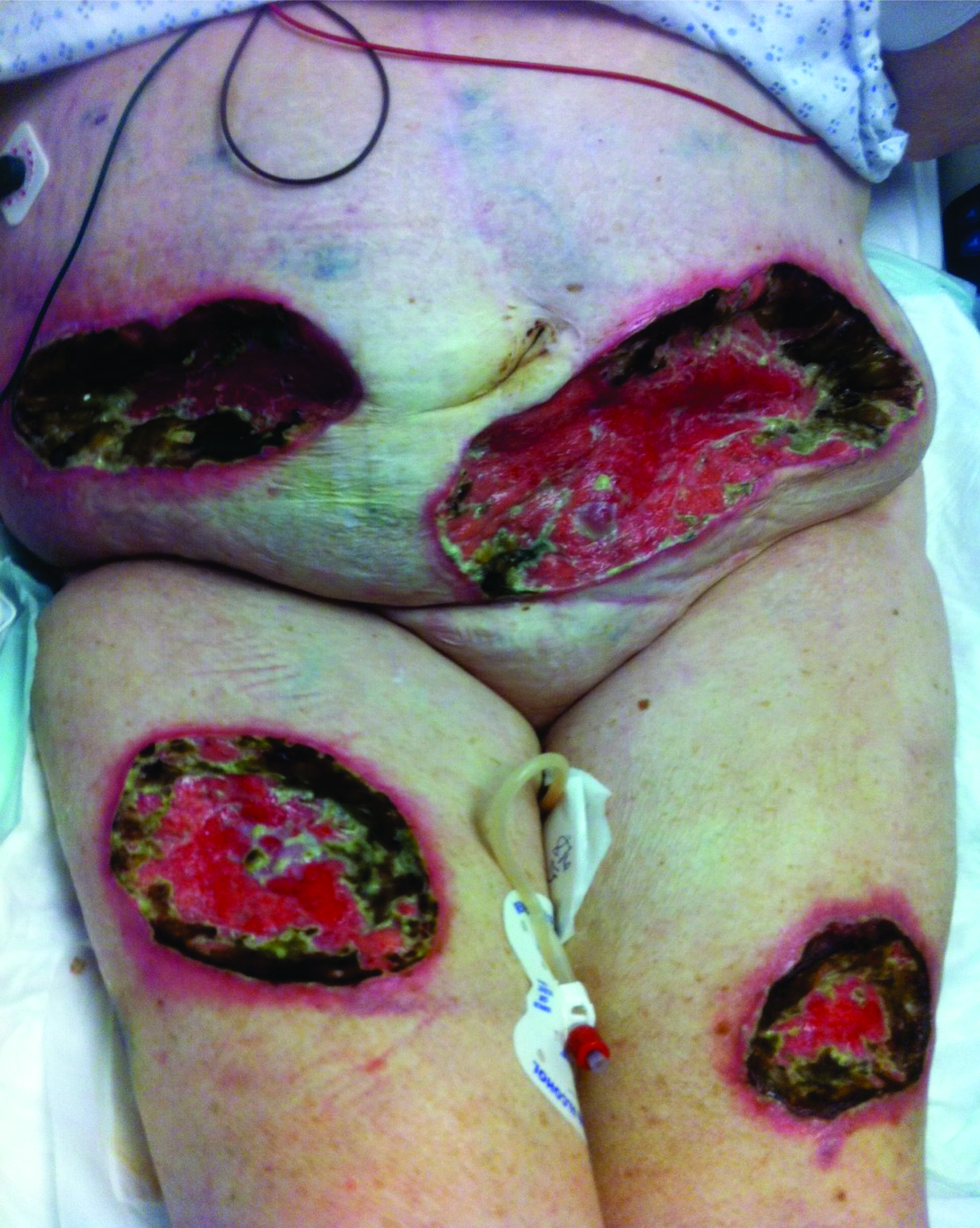Atypical later Wound