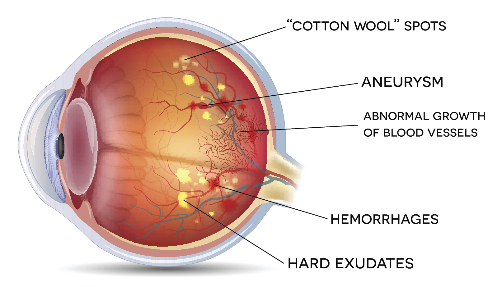 Diabetic retinopathy