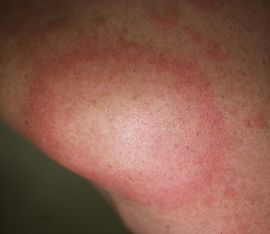Urticaria