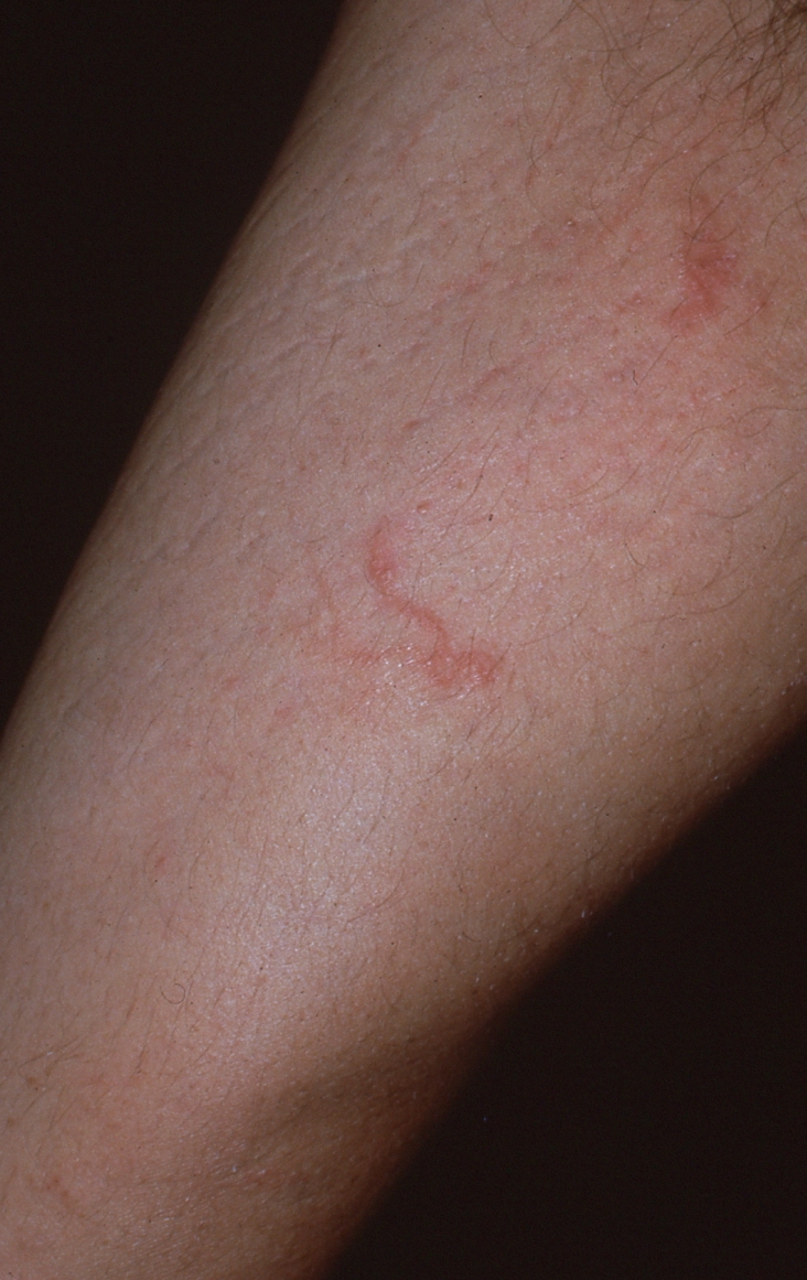 Cutaneous Larva Migrans