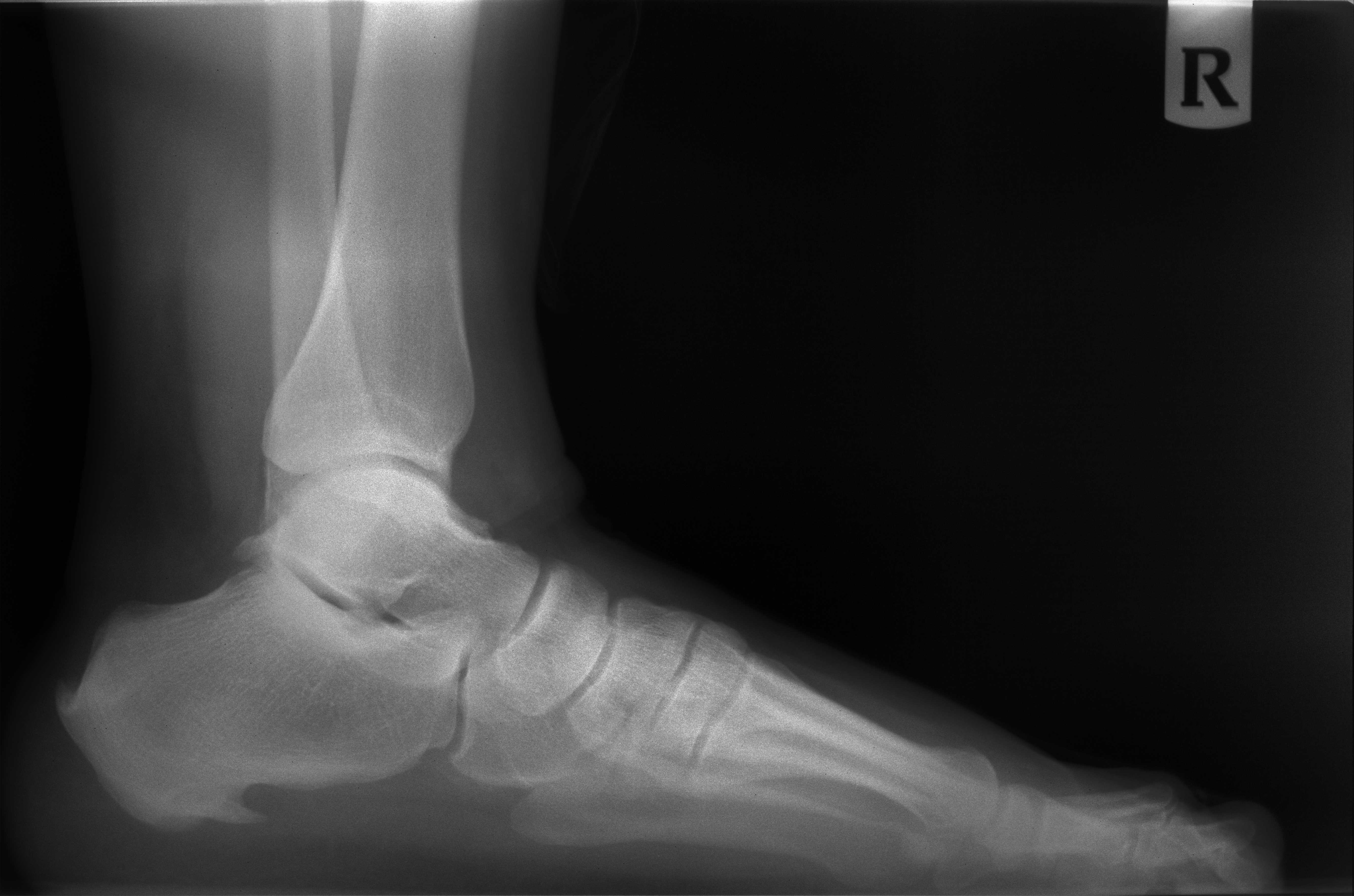 Plantar heel spur