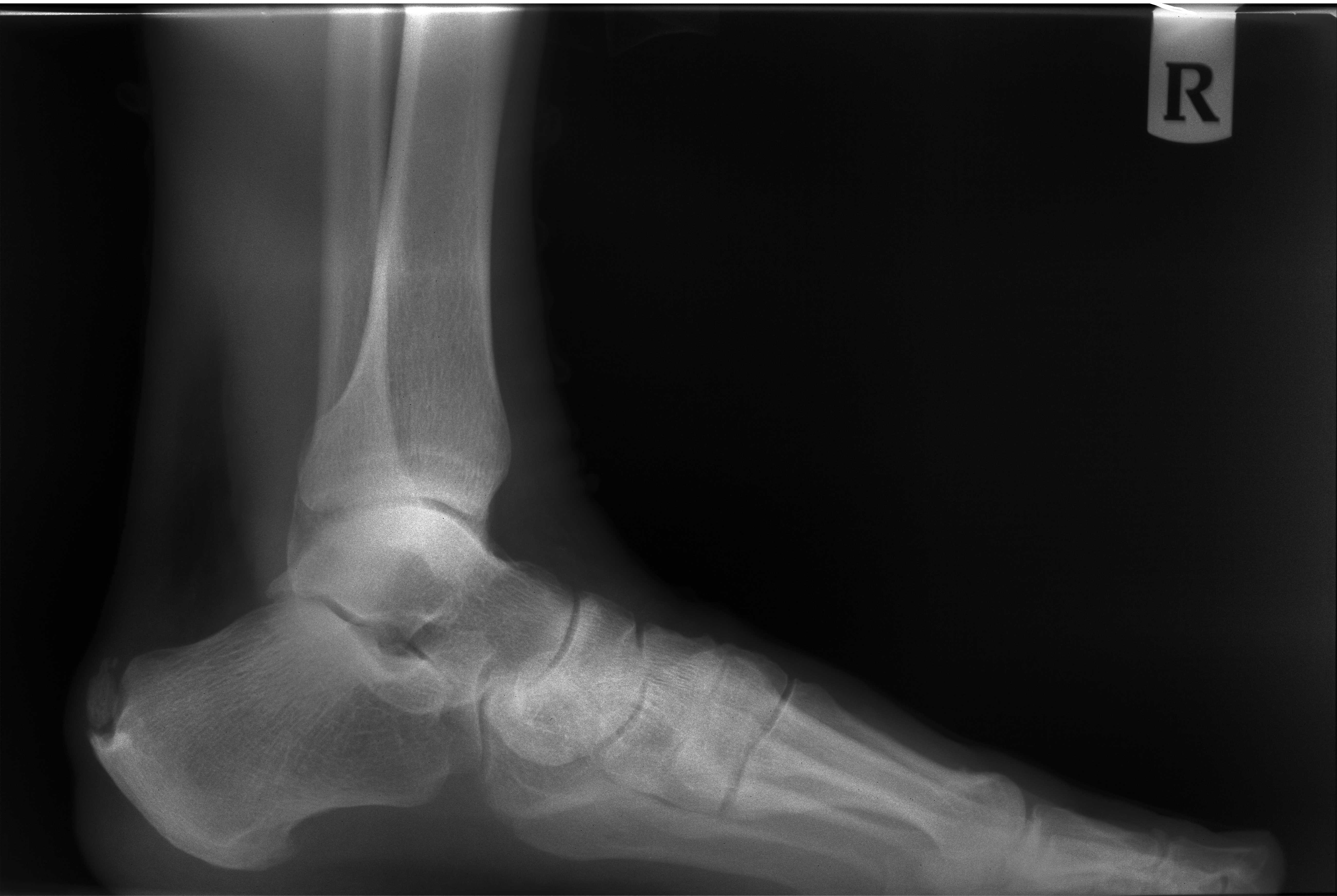 Posterior heel spur