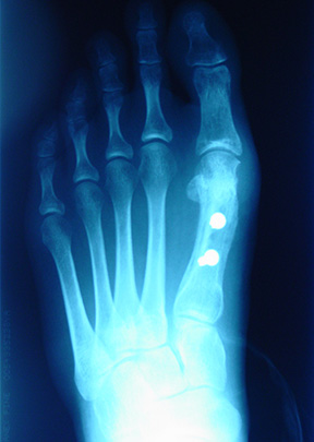 Bunion X-ray
