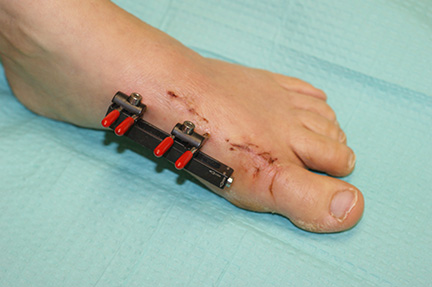 Bunion image