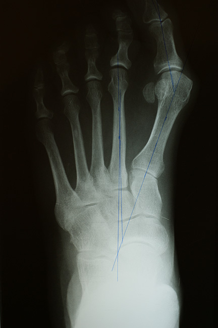 Bunion X-ray