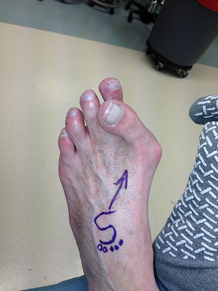 Bunion image