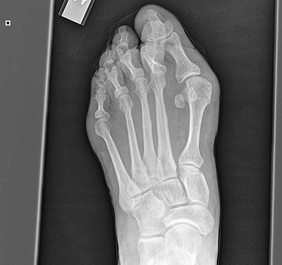 Sstress fracture