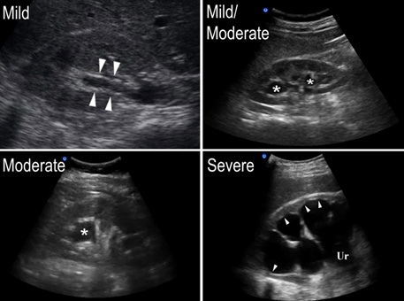 Hydronephrosis