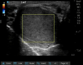 Testicular Torsion