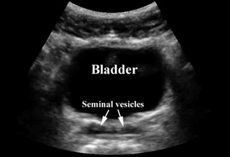 Testicular Torsion